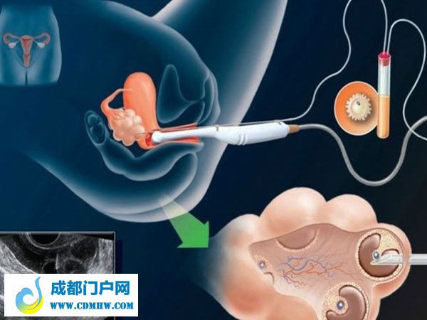 囊胚移植适合年龄小于35岁的患者